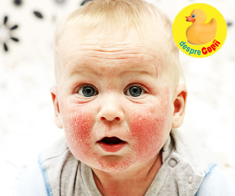 Ce este dermatita atopica si cum tratam aceasta afectiune severa a pielii bebelusului?