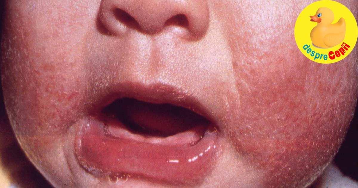 Dermatita atopica a bebelusului - stiai ca laptele matern o poate trata?
