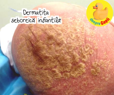 Crusta de lapte (dermatita seboreica infantila)