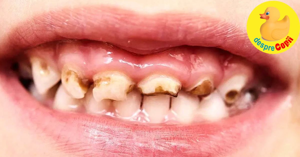 Dintii de lapte sunt foarte importanti. Iata 6 efecte ale netratarii cariilor pe dintii de lapte la copii.