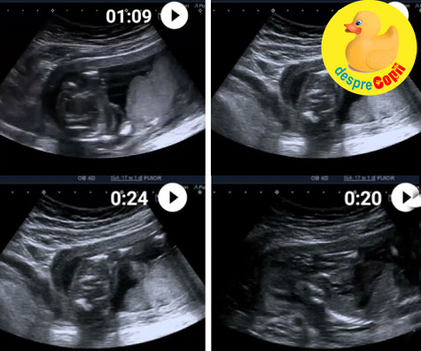 Covid in sarcina: primul control dupa boala - jurnal de sarcina