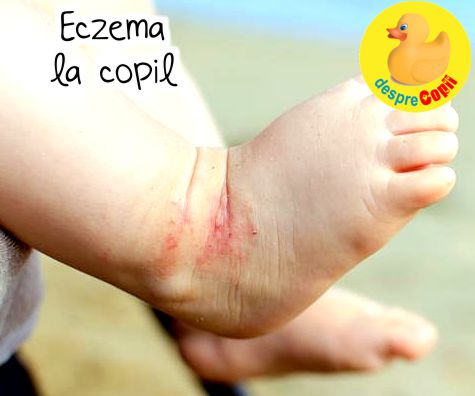 Eczema la copil. Legatura cu alergiile si cum se trateaza - sfatul medicului dermatolog