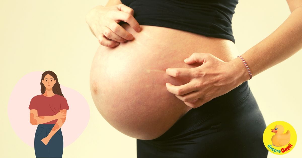 Eczema in timpul sarcinii: ce e bine de stiut