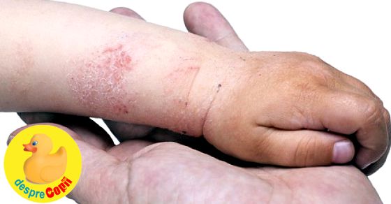 Eczema La Copil Desprecopii Com