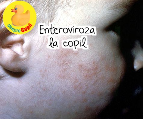 Enteroviroza la copil: tipuri, simptome si cum se trateaza