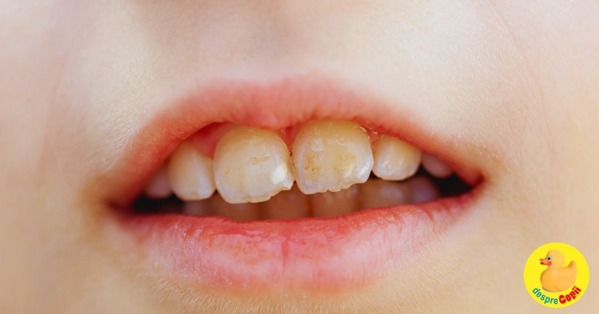 Fluorul intre prieten sau pericol pentru dintii copilului. Despre prevenirea fluorozei dentare - sfatul medicului