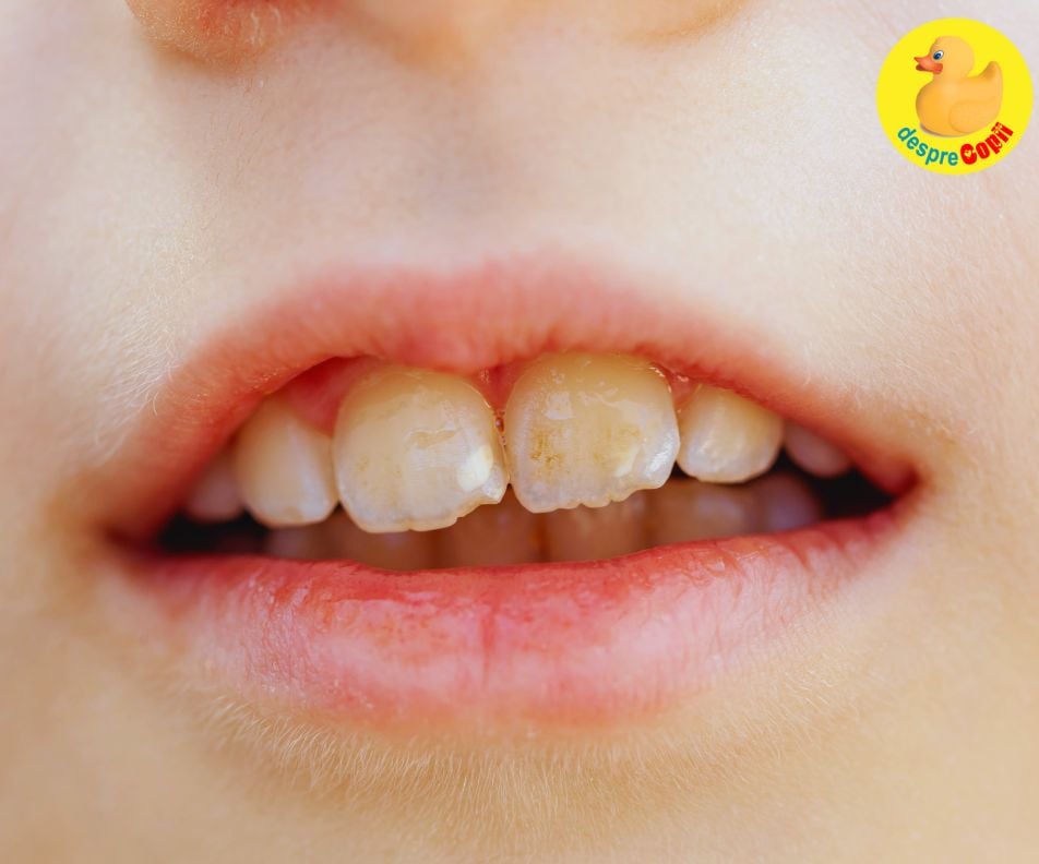 Fluorul intre prieten sau pericol pentru dintii copilului. Despre prevenirea fluorozei dentare - sfatul medicului