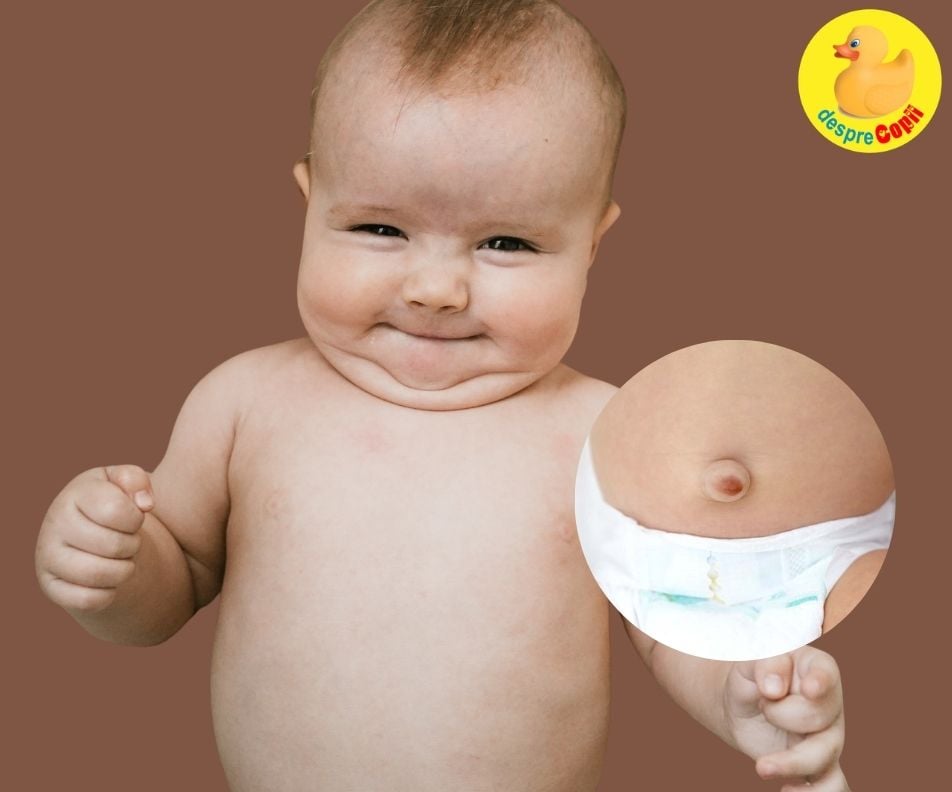 Hernia ombilicala la bebelus -  simptome si gestionare corecta a situatiei