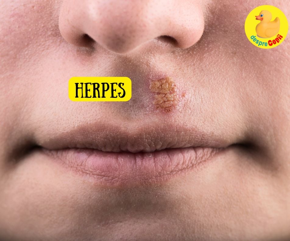 Herpesul la copii – cat de periculos este cu adevarat? 6 intrebari esentiale la care medicul ne raspunde