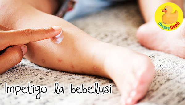 Impetigo la bebelusi -  cauze si tratament - sfatul medicului