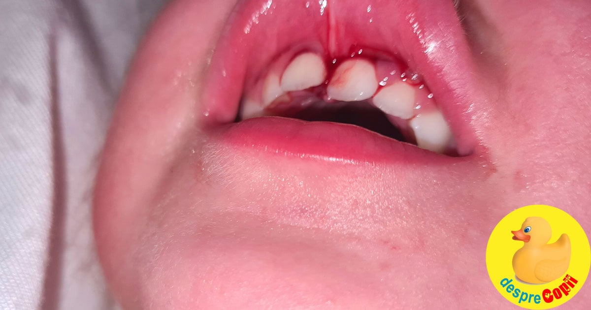 Copilul s-a ranit la un dinte de lapte? Iata ce trebuie sa stii.