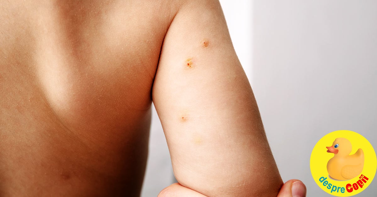 Molluscum Contagiosum sau verucile de apa la copii -  Simptome si tratament