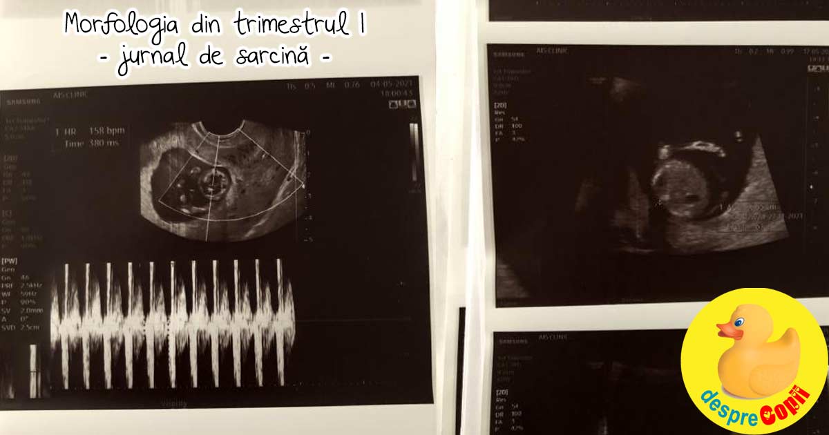 In saptamana 11 am asteptat incordati morfologia de trimestrul 1 si dublul testul: am rasuflat usurati - jurnal de sarcina