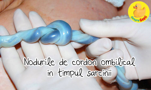 Nodurile de cordon ombilical in timpul sarcinii