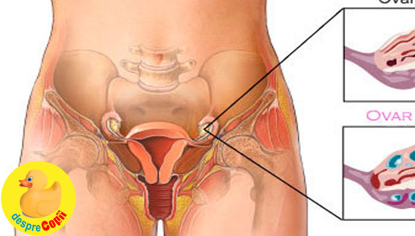 Sindromul Ovarului Polichistic Simptome și Tratament Desprecopii Com