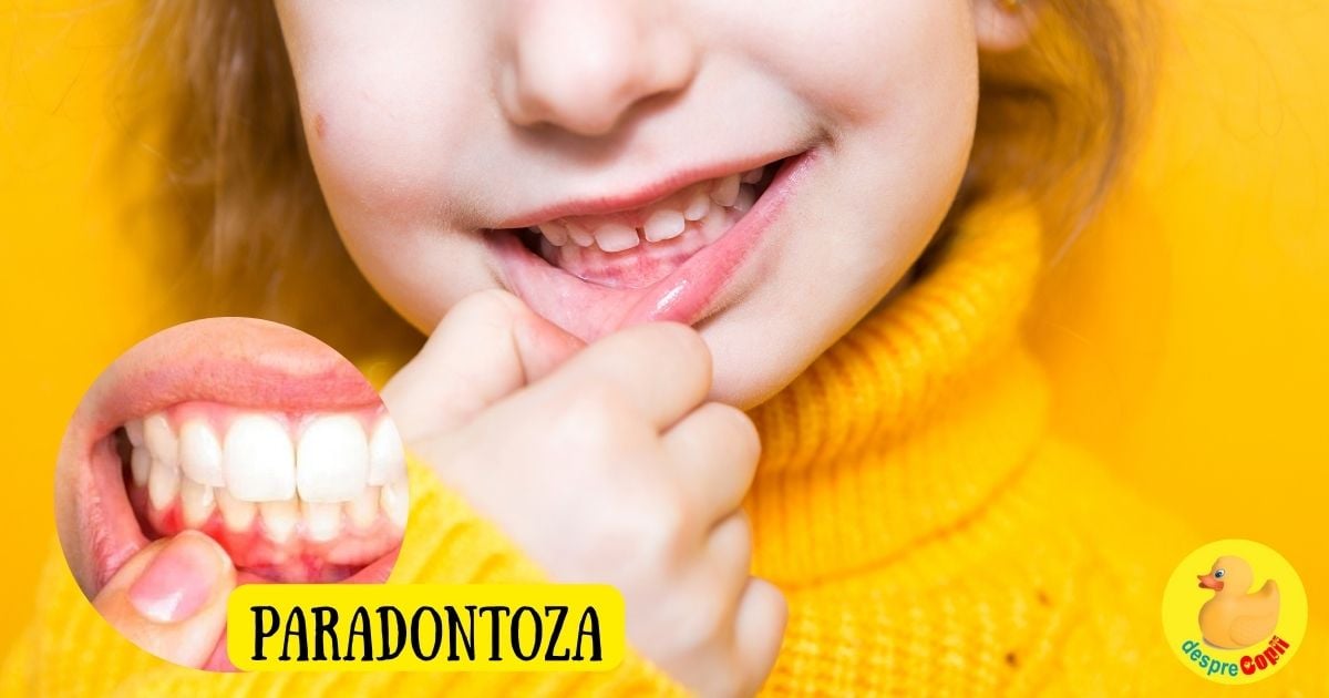 Paradontoza poate afecta si dintii copiilor. Iata cum se previne si cum se trateaza