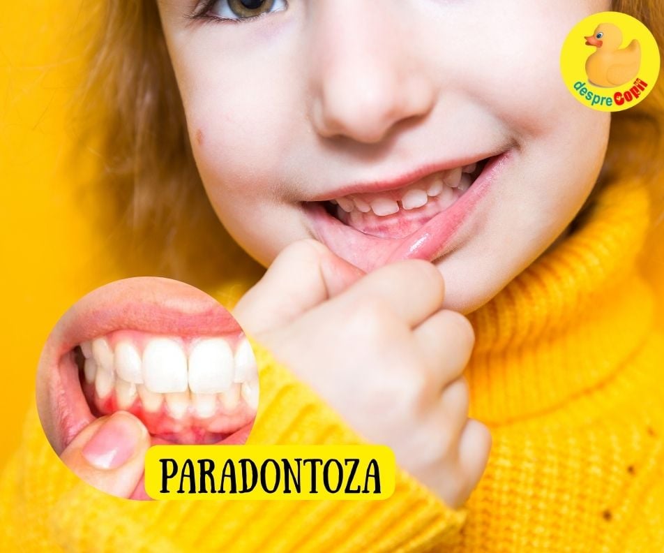 Paradontoza -  cum se previne si cum se trateaza