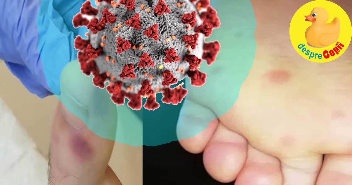 Petele de pe talpi si picioare ar putea fi un semn de infectare cu coronavirus - spun medicii spanioli