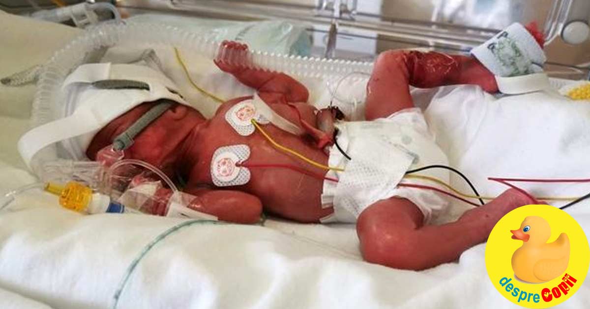 Fetita minune care s-a nascut la 25 de saptamani dupa ce mama nu a recunoscut durerile travaliului - o nastere foarte prematura