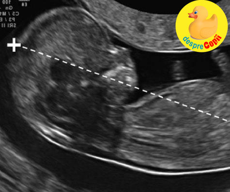 Prima morfologie de sarcina: emotii ca la un examen - jurnal de sarcina