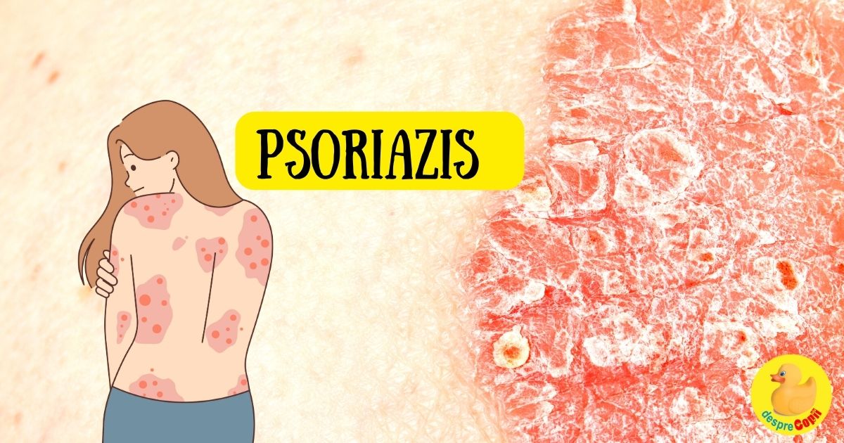 Psoriazisul la copii -  simptome, tratamente si sfaturi pentru ingrijirea pielii sensibile - sfatul medicului dermatolog