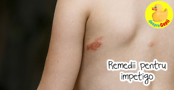 Remedii Pentru Impetigo Desprecopii Com