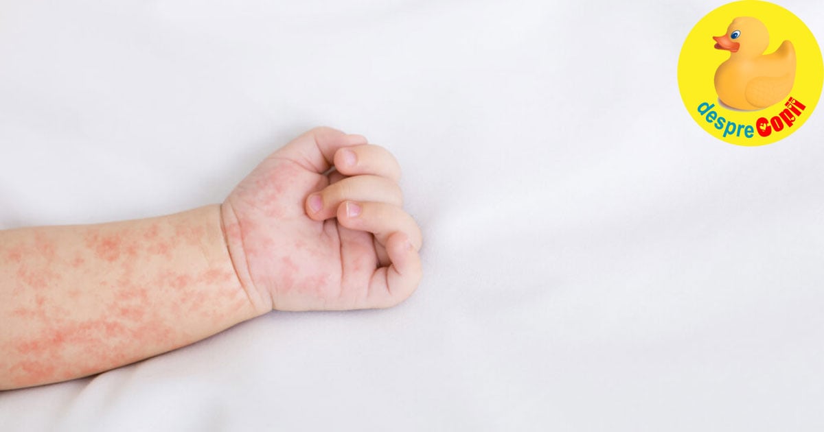 Roseola la copil: simptome si tratament - sfatul pediatrului