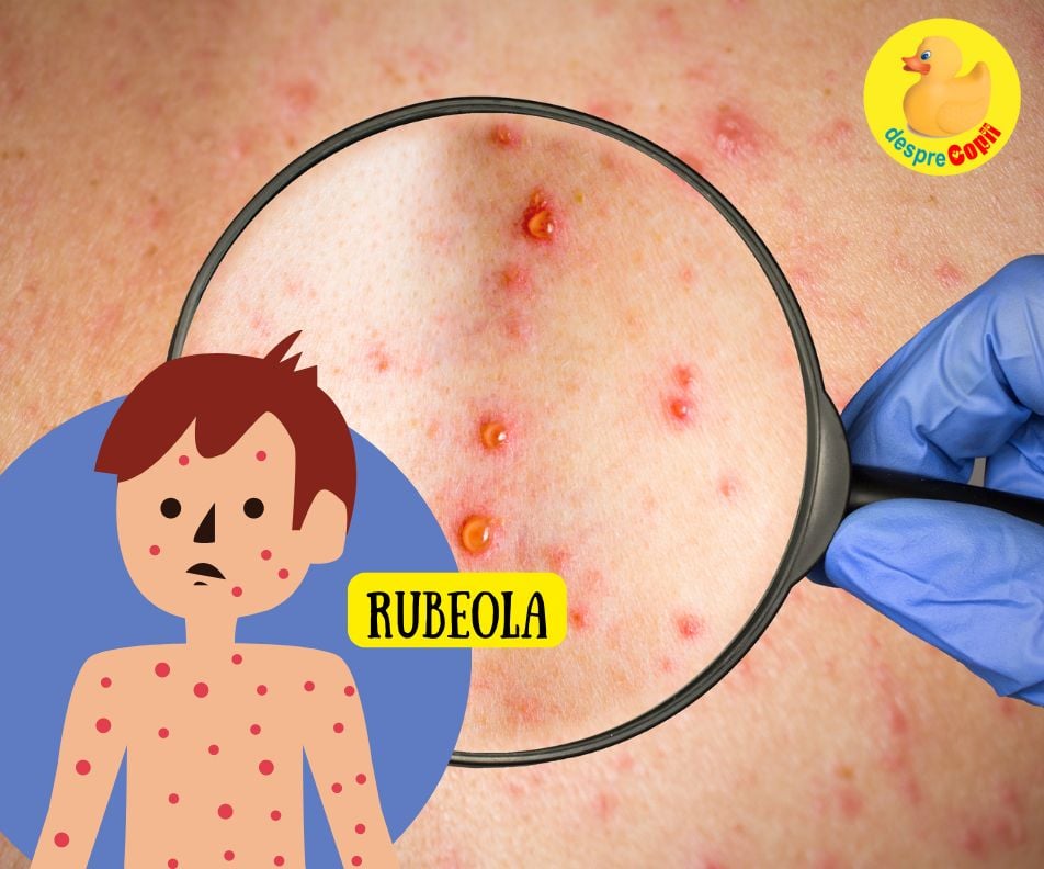 Rubeola la copil - simptome, tratament si prevenire.  Un ghid de la primele pete până la vindecare