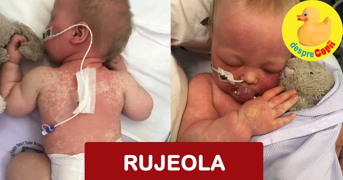 Lupta infricosatoare a bebelusei mele cu rujeola - povestea unei mamici