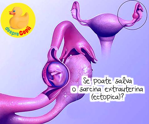 Se poate salva o sarcina extrauterina (ectopica)?