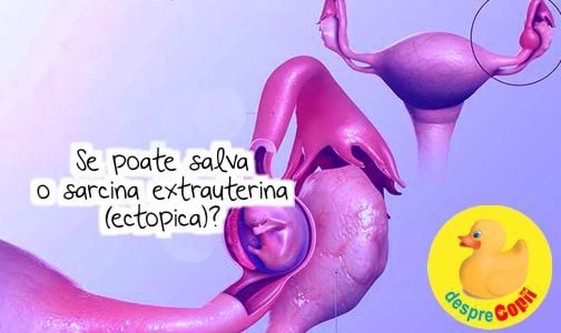 Se poate salva o sarcina extrauterina (ectopica)? Iata ce spun medici.