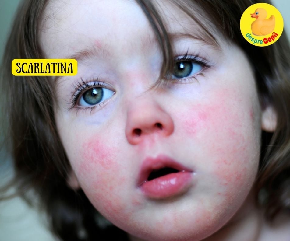 Scarlatina la copil. Ce simptome are, complicatii si tratament - sfatul medicului