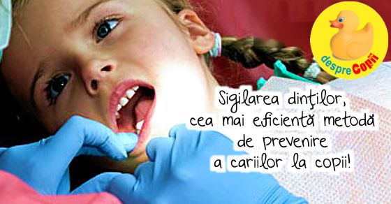 Sigilarea dintilor previne cariile