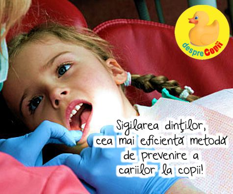 Sigilarea dintilor previne cariile