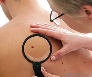 9 conceptii gresite despre alunite si melanom