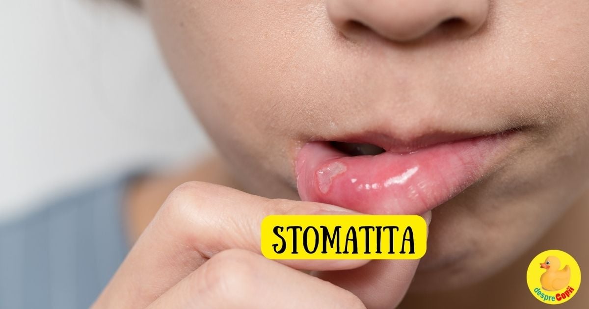 Stomatita la copil: simptome, tratament si atentionari - sfatul medicului