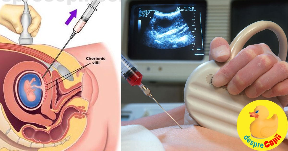 Testul de vilus corionic (prelevarea de vilozitati coriale): cand si de ce se efectueaza