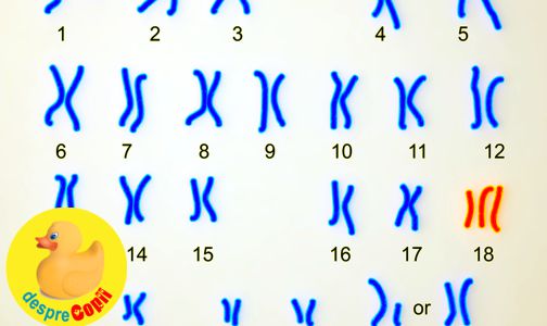 Trisomia 18 sau sindromul Edward