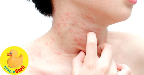 Urticaria la copil: cauze, tipuri si tratament