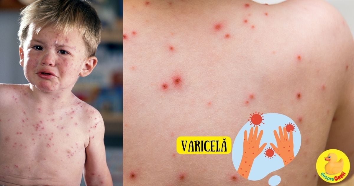 5 lucruri pe care ar trebui sa le stii despre varicela si zona zoster