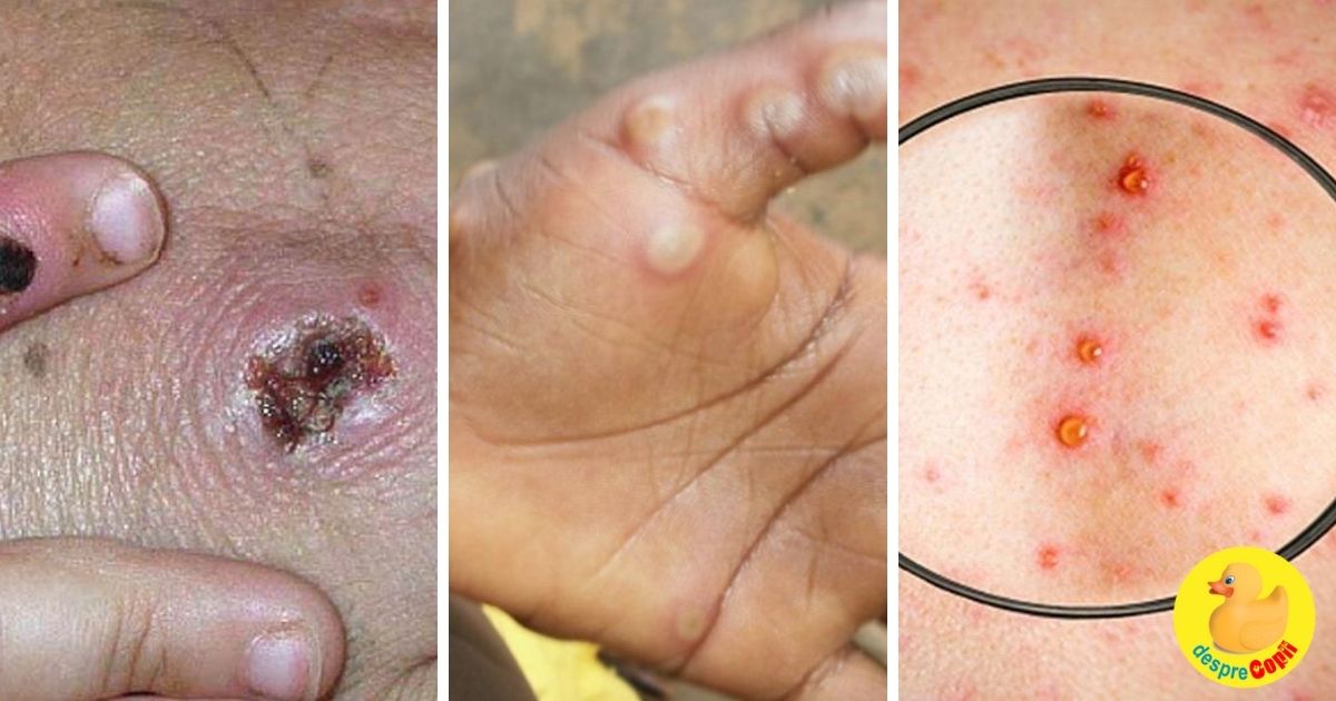 Variola maimutei sau monkeypox - ce simptome are si ce se stie despre acest virus