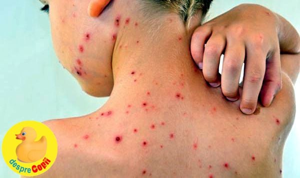 Tratamentul varicelei sau varsatului de vant - la copil