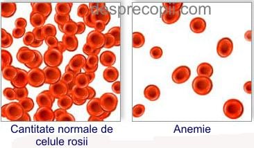 anemie sange