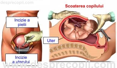 nasterea cezariana