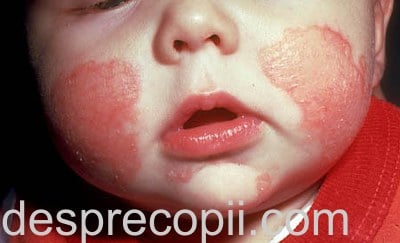 Eczema La Copil Desprecopii Com