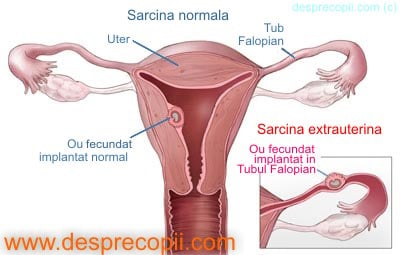 sarcina extrauterina