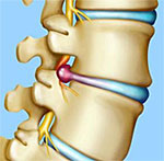 Hernia De Disc Tehnici Minim Invazive Microchirurgicale