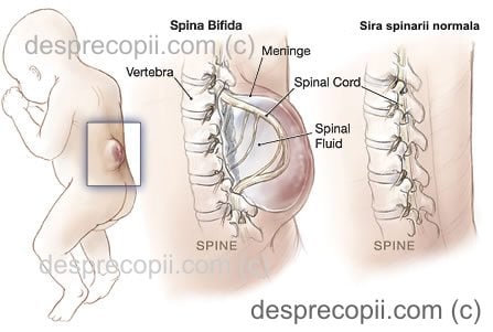 Spina Bifida sau de coloana la nou-nascuti: preventie, detectare, tipuri si tratament imediat |