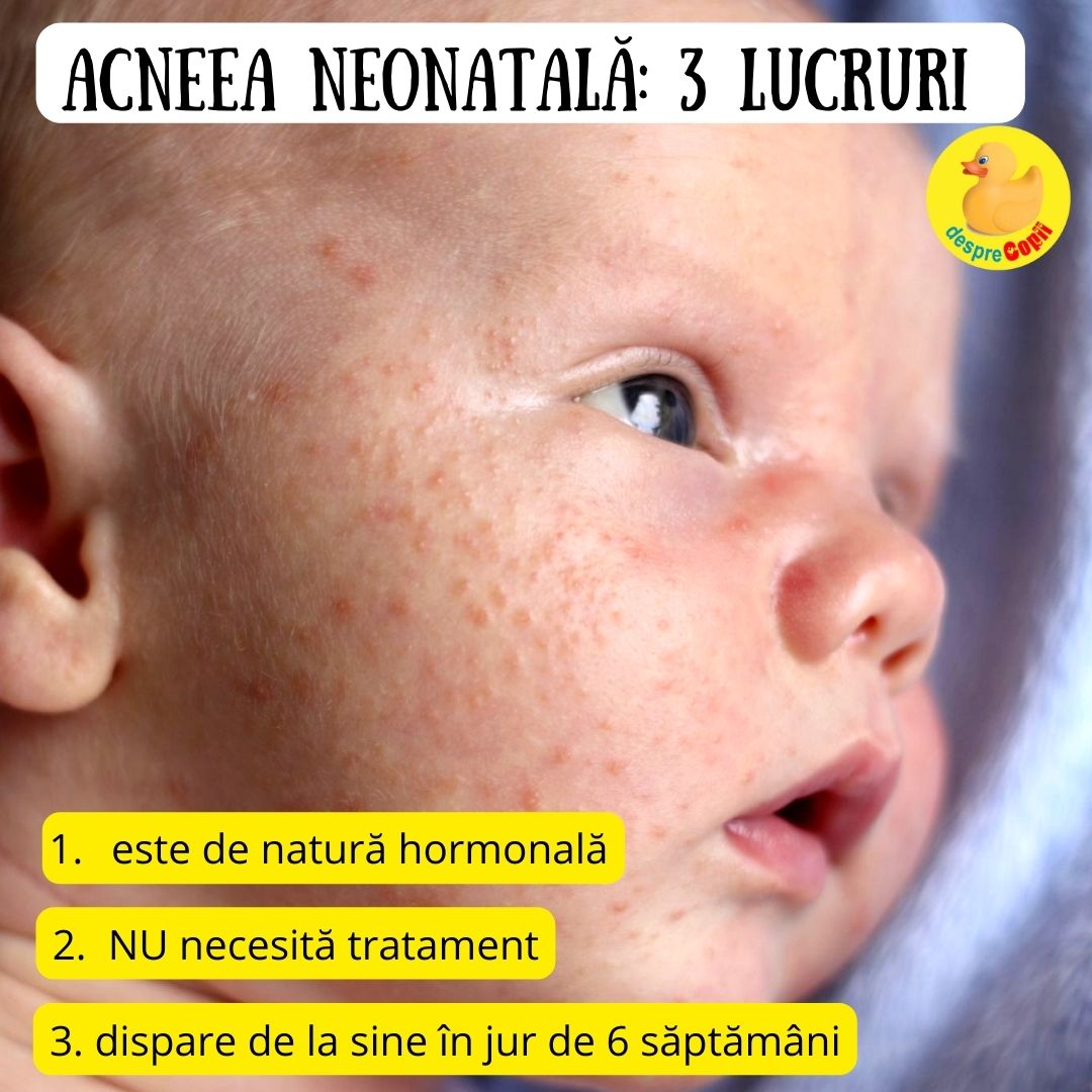 acnee neonatala