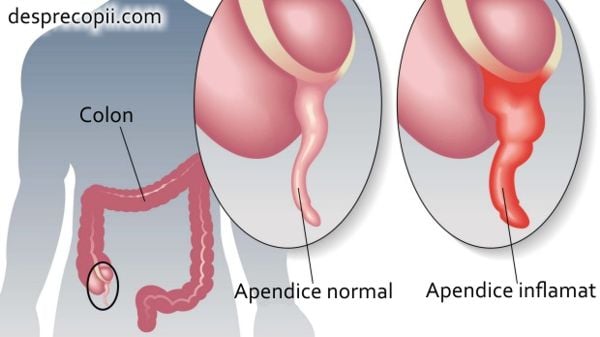 apendicita copil